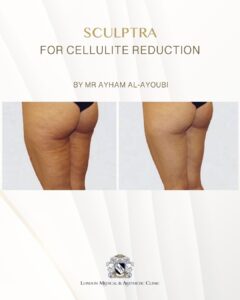 Sculptra for Buttock Enhancement by Dr Ayham Al-Ayoubi