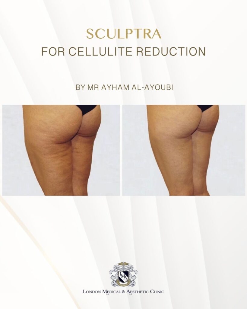 Sculptra for Buttock Enhancement by Dr Ayham Al-Ayoubi