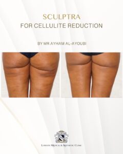 Sculptra for Buttock Enhancement by Dr Ayham Al-Ayoubi