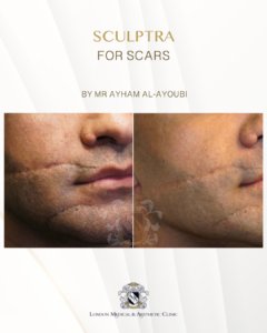 Sculptr for Scar by Dr Ayham Al-Ayoubi