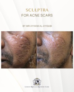 Sculptr for Scar by Dr Ayham Al-Ayoubi