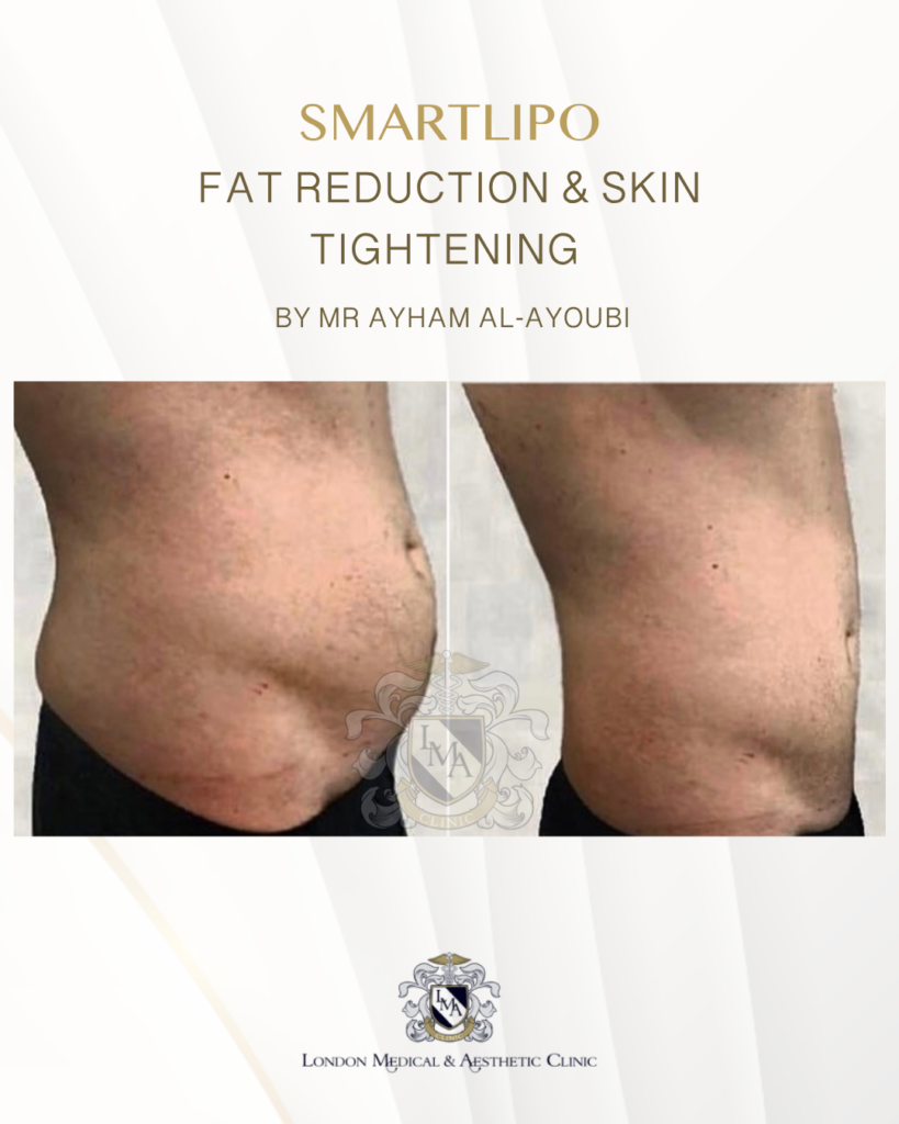 Smartlipo Laser Liposuction - By Dr Ayham Al-Ayoubi