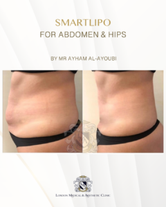 Smartlipo Laser Liposuction - By Dr Ayham Al-Ayoubi
