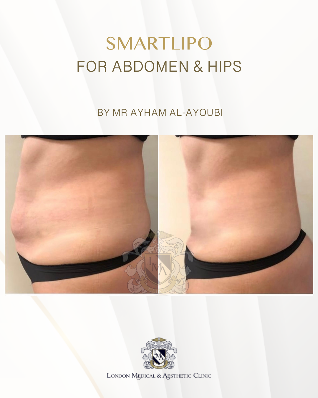 Smartlipo Laser Liposuction - By Dr Ayham Al-Ayoubi