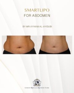 Smartlipo Laser Liposuction - By Dr Ayham Al-Ayoubi