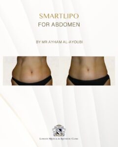 Smartlipo Laser Liposuction - By Dr Ayham Al-Ayoubi