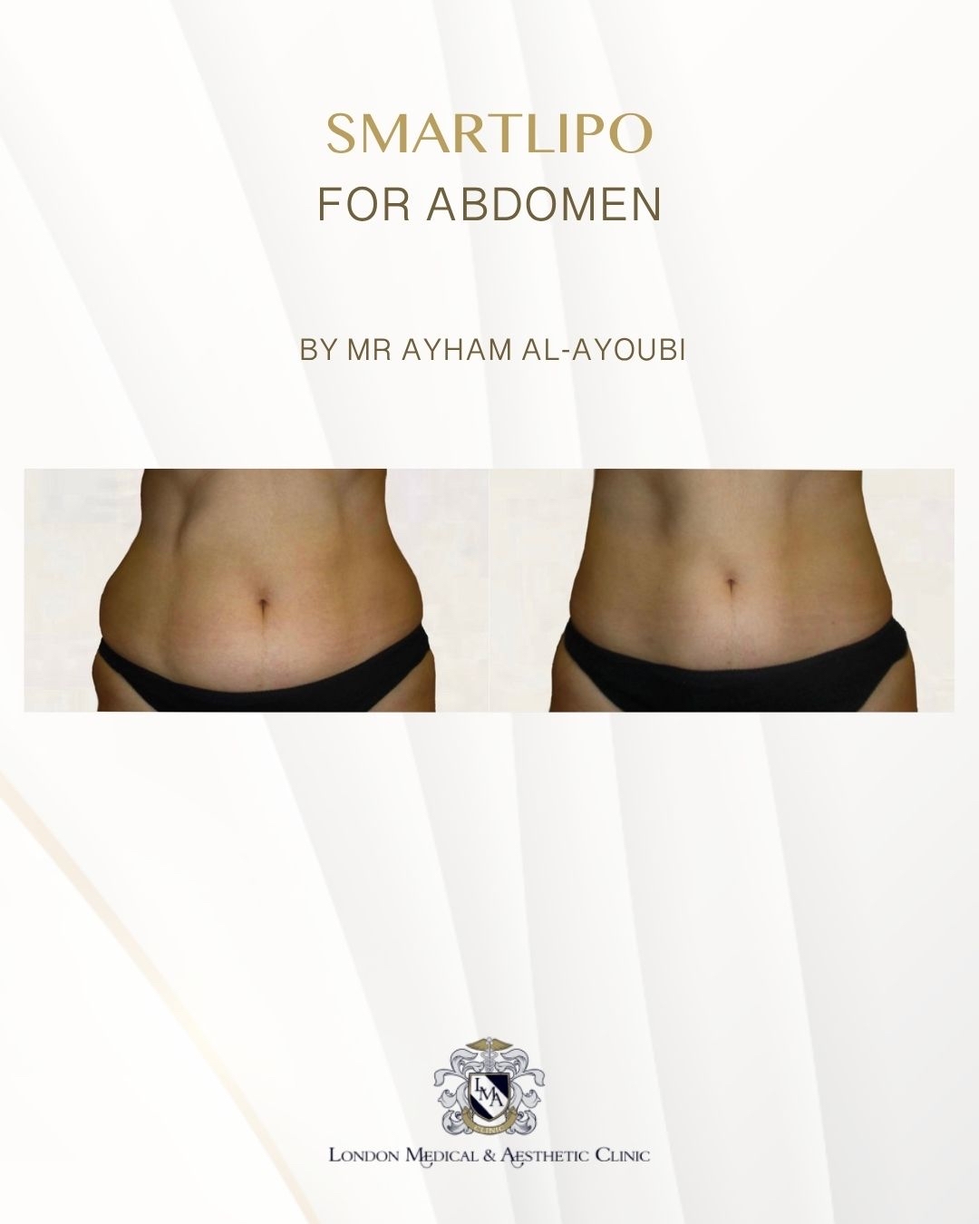 Smartlipo Laser Liposuction - By Dr Ayham Al-Ayoubi